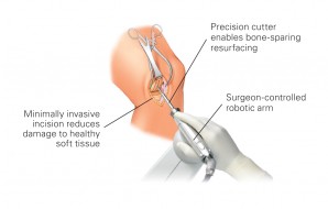 Joint Replacement Surgery in India