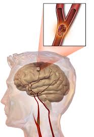 Stroke treatment using thrombectomy