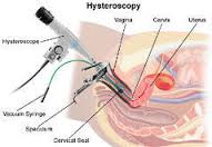 Angiography