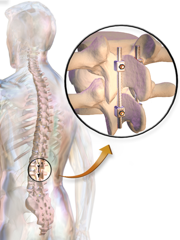 spinal-fusion-surgery